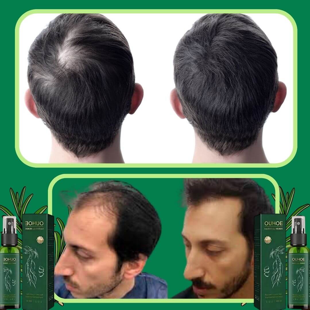 Tonico Para Crecer El Pelo | OUHOE™